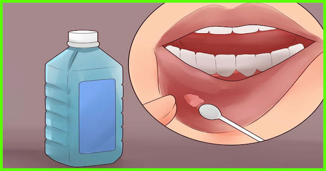 Mouth ulcers are a very common ailment among people.