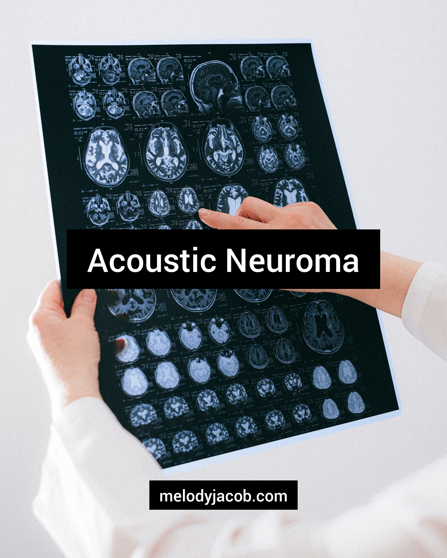What is Acoustic Neuroma
