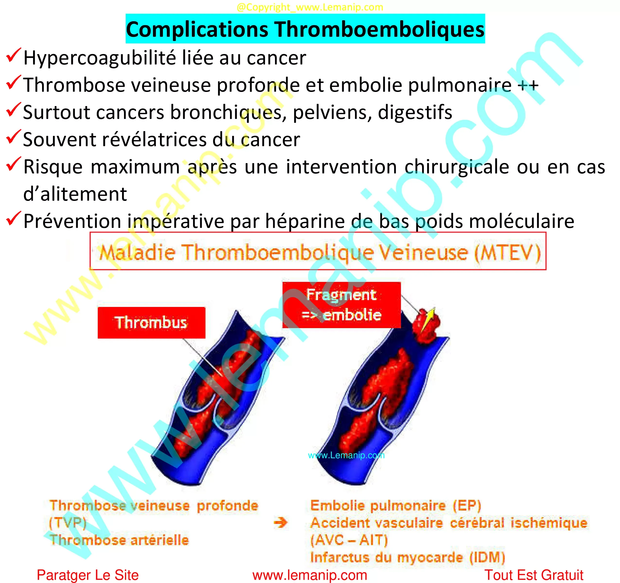 Complications Thromboemboliques