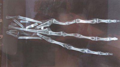 This is the X-ray of the 3 fingered Alien entity found in Peru.