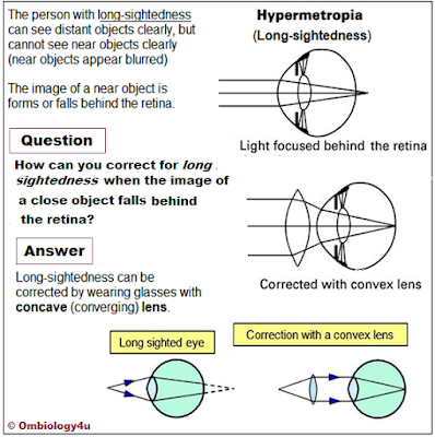 The Eye - Correction of Long sightedness