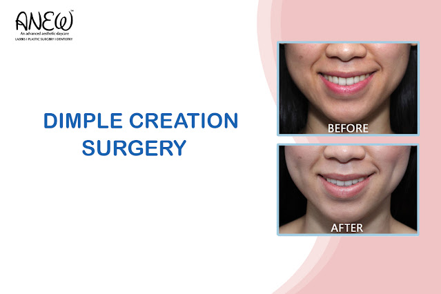 Dimple Creation Surgery in Bangalore