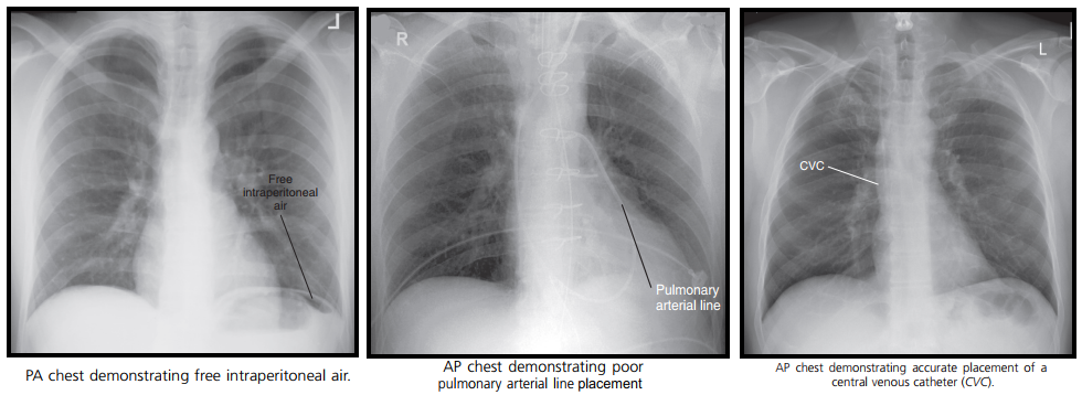 mesothelioma chest x ray,asthma chest x ray,asthma lungs x ray,mesothelioma x ray,cdh xray,asbestosis chest x ray,asbestos lung x ray,asbestosis x ray,hmi xray,asthma x ray