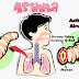 Asthma kanak kanak