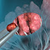 Endometrial Biopsy of the Uterus