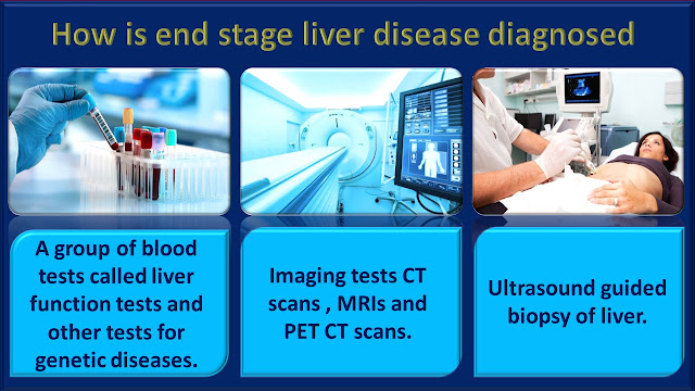 How an end stage liver disease or chronic liver failure is diagnosed ?