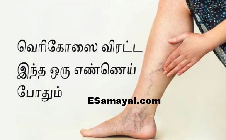 வெரிகோஸ் வெயின் பிரச்னைக்கு சைப்ரஸ் எண்ணெய் ! #varicoseveins