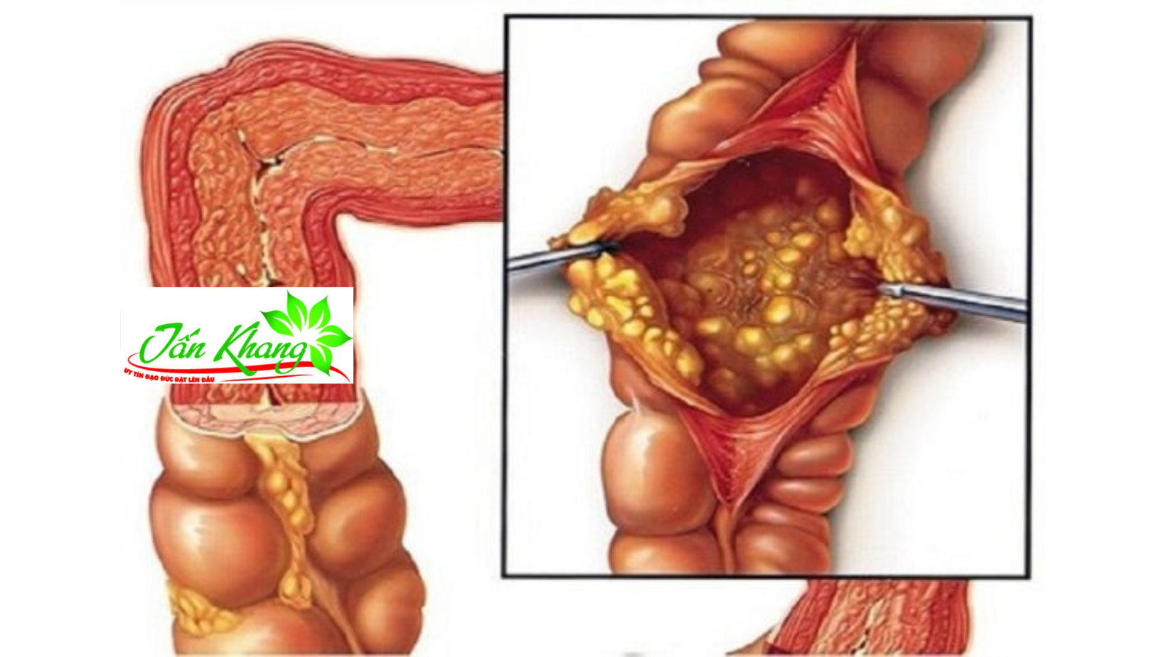 Cách chẩn đoán và điều trị bệnh viêm đại tràng mãn tính