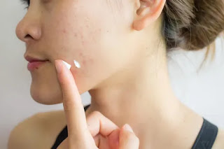 Simple Methods to Clear Up Acne Scars