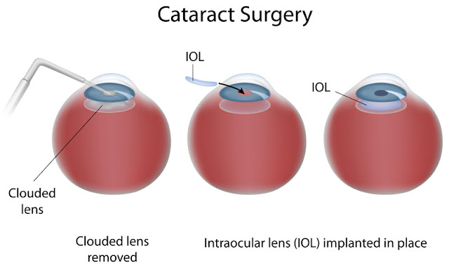 Intraocular Lens (IOL)