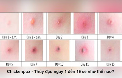 Hình ảnh nốt mụn nước thủy đậu qua từng ngày