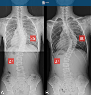 脊椎側彎矯正案例31~3個月改善極重度胸椎側彎60度→50度