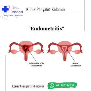 Endometritis