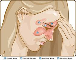 how to cure sinus permanently