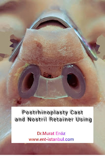 Modified Aluminum Cast, Postrhinoplasty Cast Using,Effect of postrhinoplasty taping on swelling in patients with thick skinned nose,Nostril Retainer,