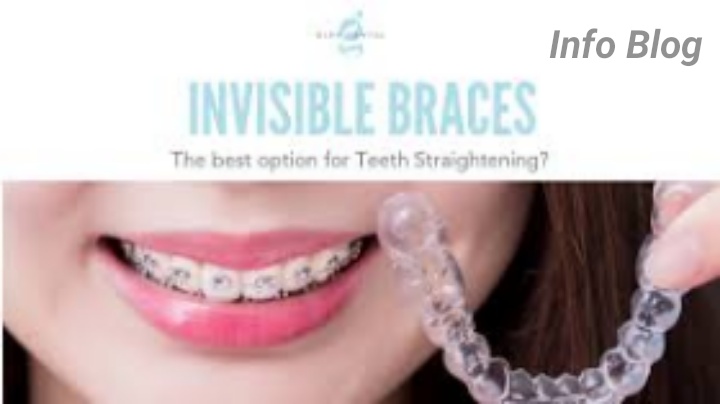 Best invisible braces