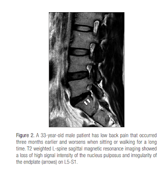 Endplate Fracture