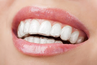 Phương pháp niềng răng không mắc cài 3D Clear-2