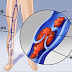 Les varices seraient un symptôme précoce d’une thrombose veineuse profonde