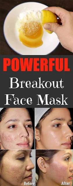 Blotches Fighting Face Mask For Acne & Blackheads