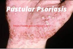 Pustular Psoriasis