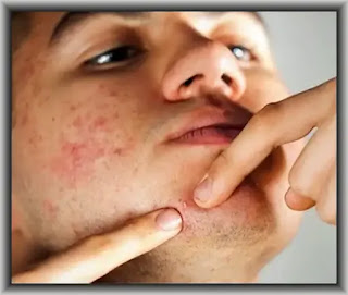 acneea la adulti cauze prevenire tratamente eficiente