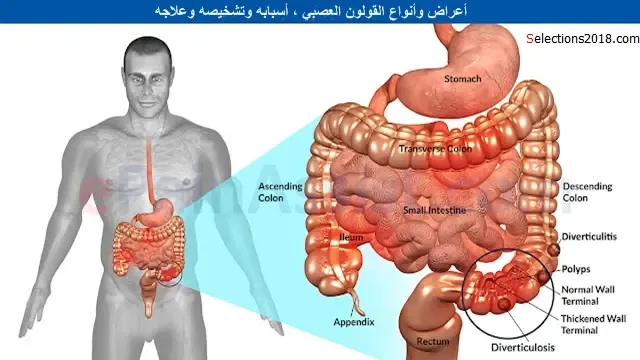 القولون العصبي أعراضه