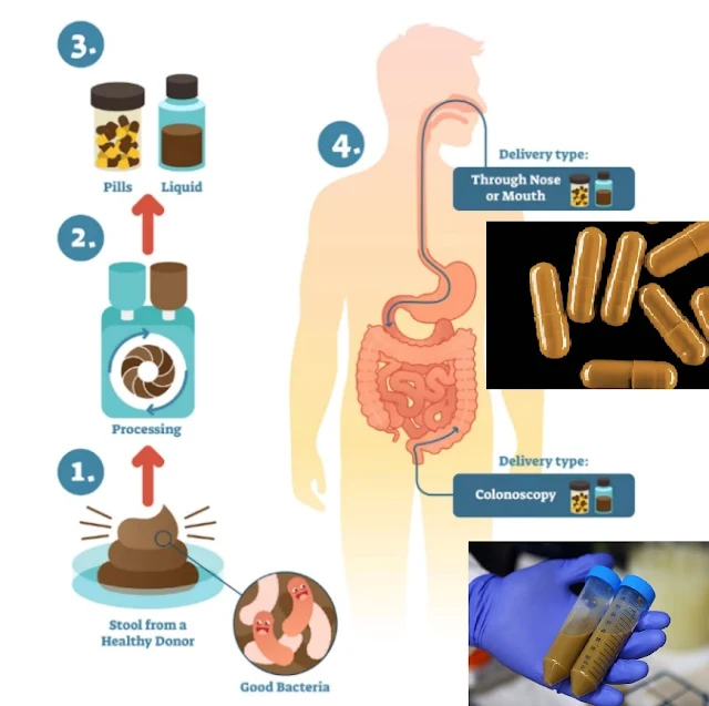 What is fecal transplant?