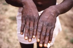 Imagem Monkeypox / CDC