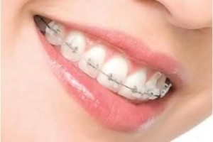 Phương pháp niềng răng mắc cài sứ-1