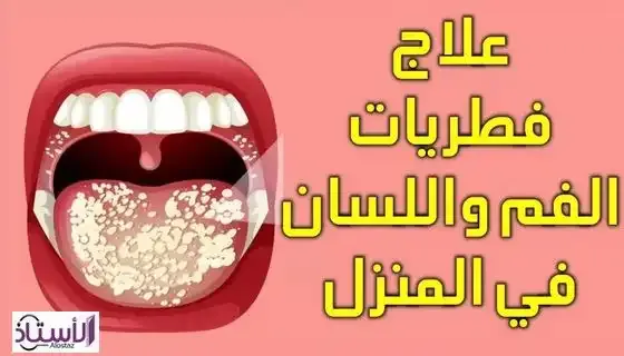 Benefits-of-honey-in-treating-tongue-fungus