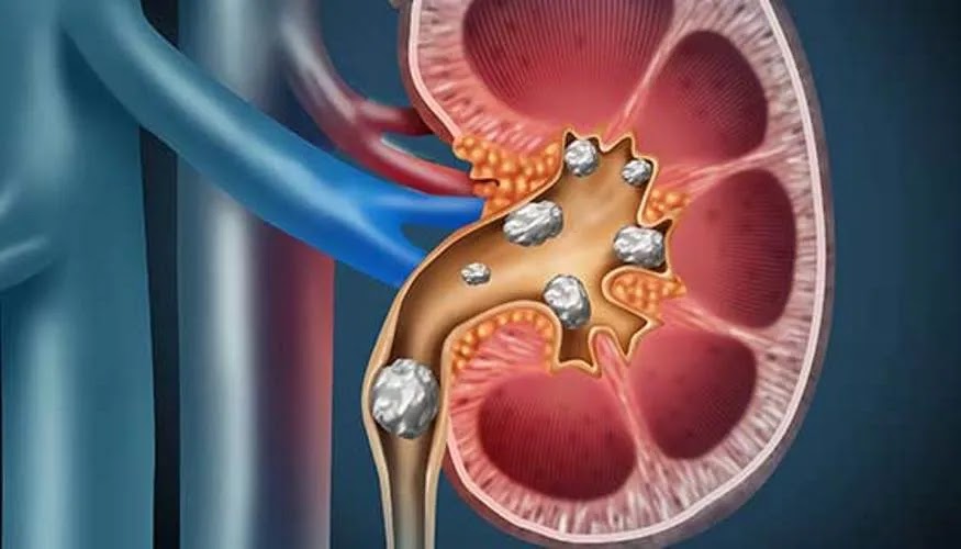 Kidney Stones: Know Its Causes, Symptoms, Treatment!