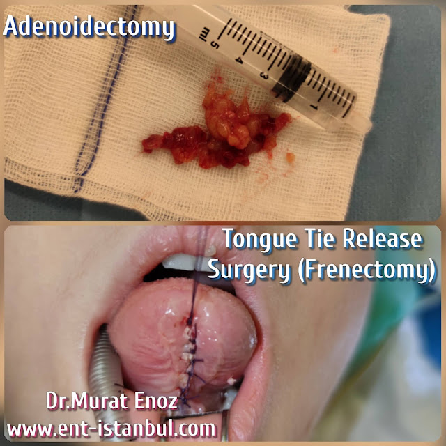 V-shaped palate,Deep and narrow upper jaw,U-shaped palate,Correct Tongue Resting Position, Jaw and Facial Development in Children,Adenoid Hypertrophy,Tongue tie