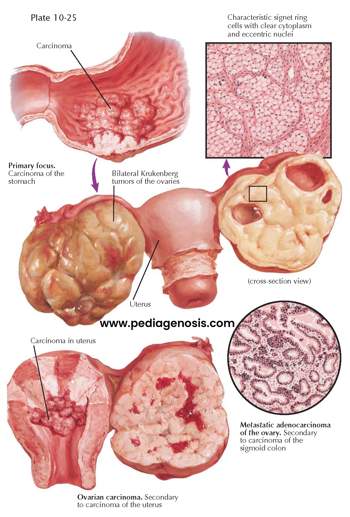 SECONDARY OVARIAN CARCINOMA