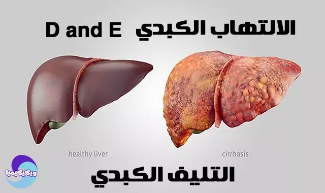 Hepatitis D and E Virus and Cirrhosis