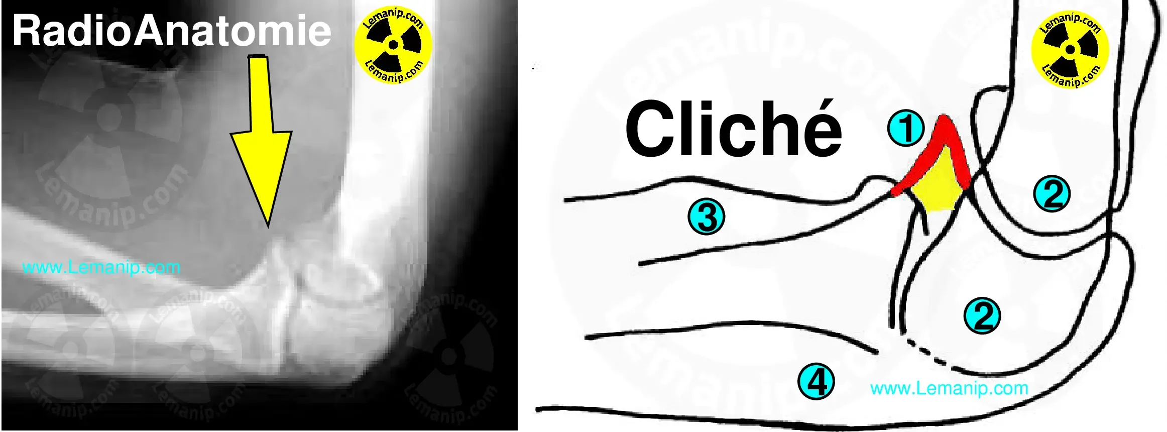 Rx Apophyse coronoïde en flexion + Radio Anatomie