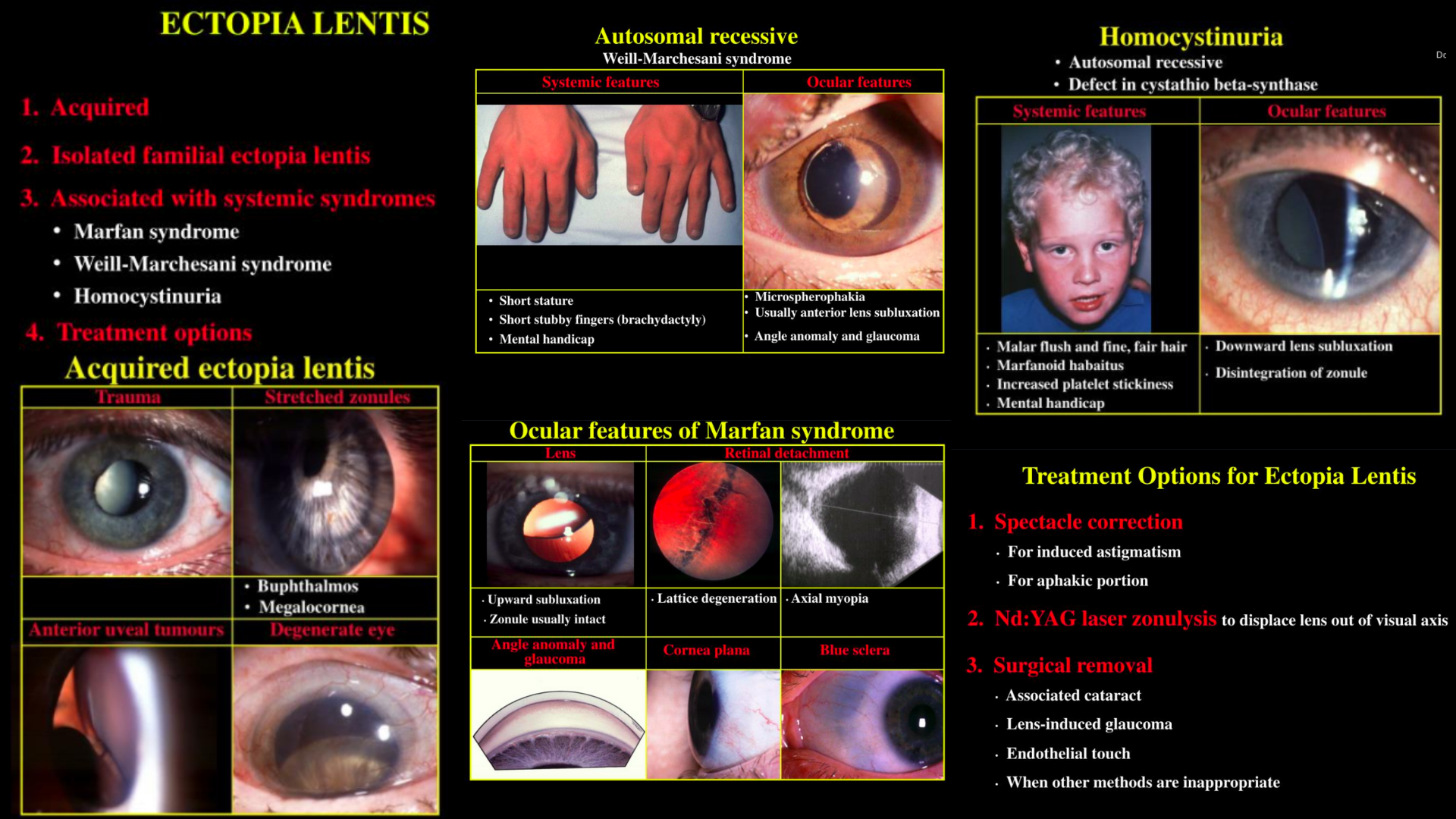 Verschillende goederen Dinkarville Afleiding Ectopia Lentis - Acquired and Systemic Associations - Marfan syndrome,  Weill-Marchesani syndrome, Homocystinuria .