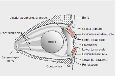 Anophthalmic Socket Ocular prosthesis