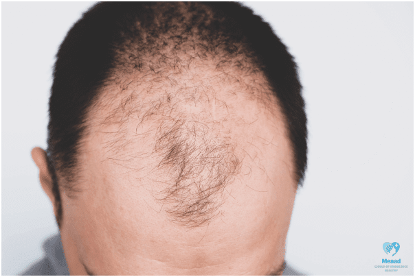 male pattern baldness, men hair thinning, baldness in men, man regrows hair, hair thinning back of head male
