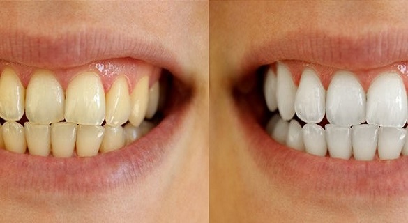 Dişler neden sararır, evde nasıl diş beyazlatılır