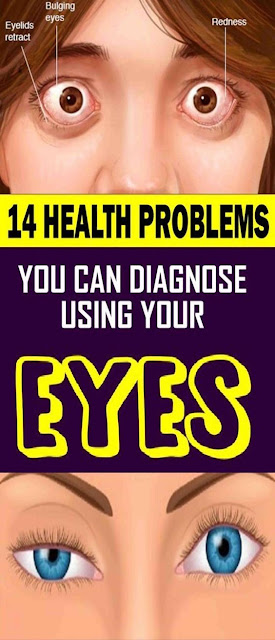 14 Health Problems You Can Diagnose Using Your Eyes