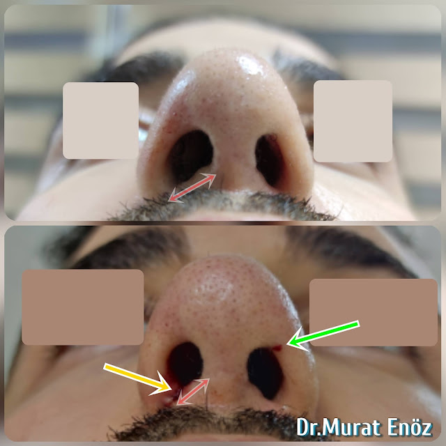 Alar Base Resection, Nose Filler Injection To The Nose Tip, Nostril Asymmetry, Revision Nose Tip Aesthetic
