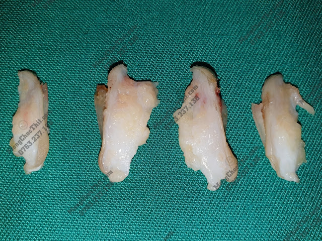 Phần móng và khóe chân sau khi tiểu phẫu cắt ra Phần móng và khóe chân sau khi tiểu phẫu cắt ra