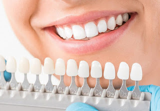 Áp dụng chỉnh răng hô bằng răng sứ có hiệu quả khi nào?-3