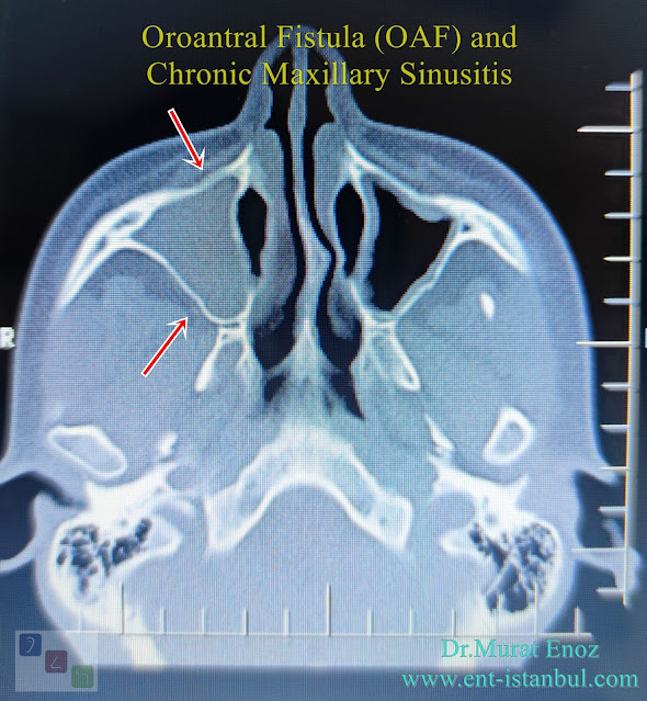 Chronic Maxillary Sinusitis,Oroantral fistula, OAF,Dental Sinusitis, Odontogenic Sinusitis,