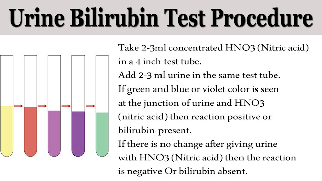Urine Bilirubin test procedure