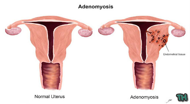 adenomyosis gallbladder