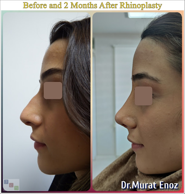 Before and 2 months after nose aesthetic operation - natural rhinoplasty - nose job istanbul