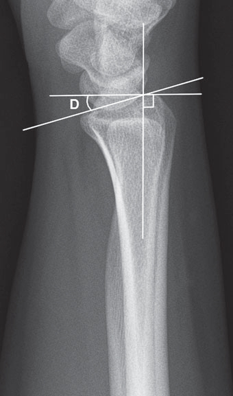 Distal Radius (Colles) Fracture Case