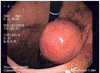 Know About Gastro-Intestinal Stromal Tumour (GIST)